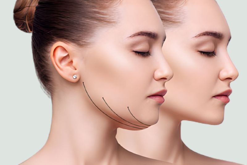 Face & Neck Liposuction