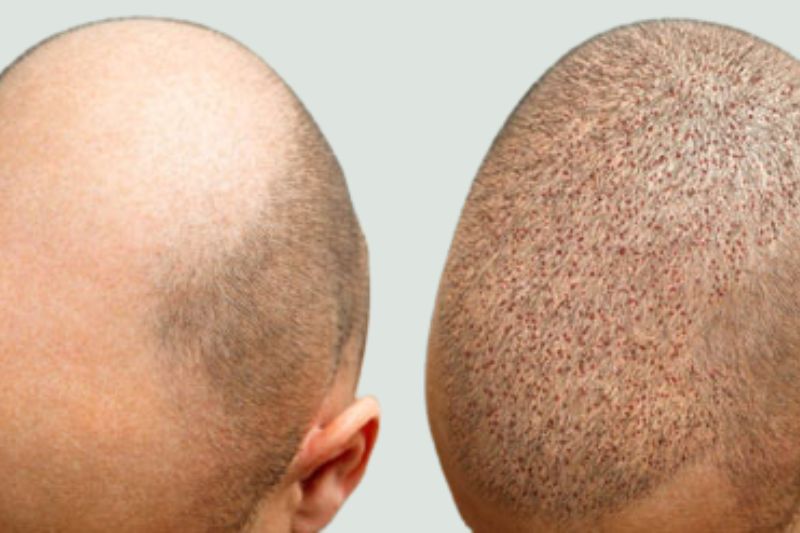 Hair Transplant